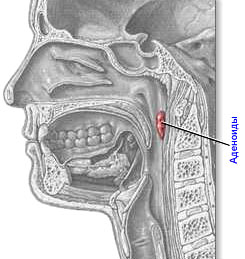 Аденоидные разрастания